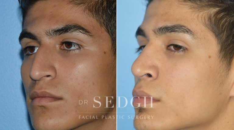 Rhinoplasty Before and After | Sedgh