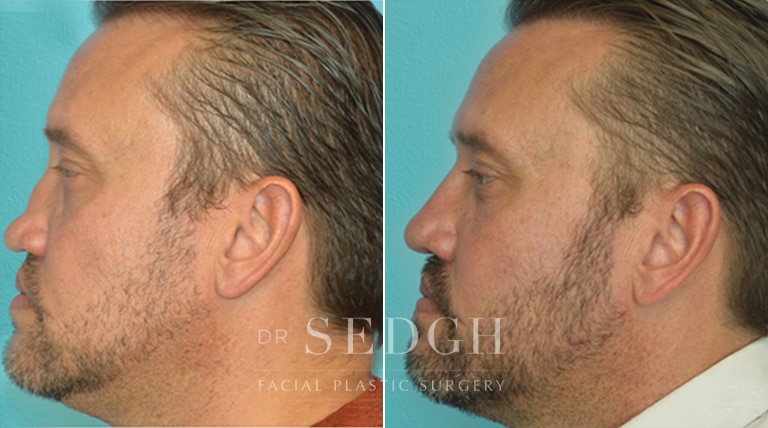 Rhinoplasty Before and After | Sedgh