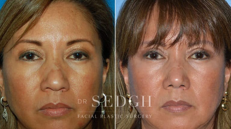 Female Rhinoplasty Before and After | Sedgh