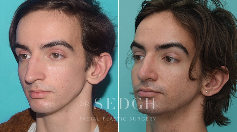 Male Rhinoplasty Before and After | Sedgh