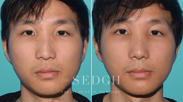 Male Rhinoplasty Before and After | Sedgh