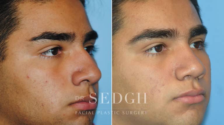 Latino Rhinoplasty Before and After | Sedgh