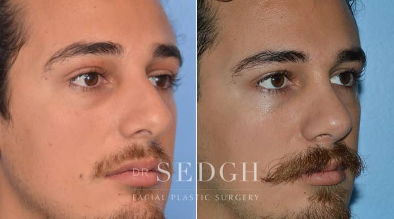 Latino Rhinoplasty Before and After | Sedgh