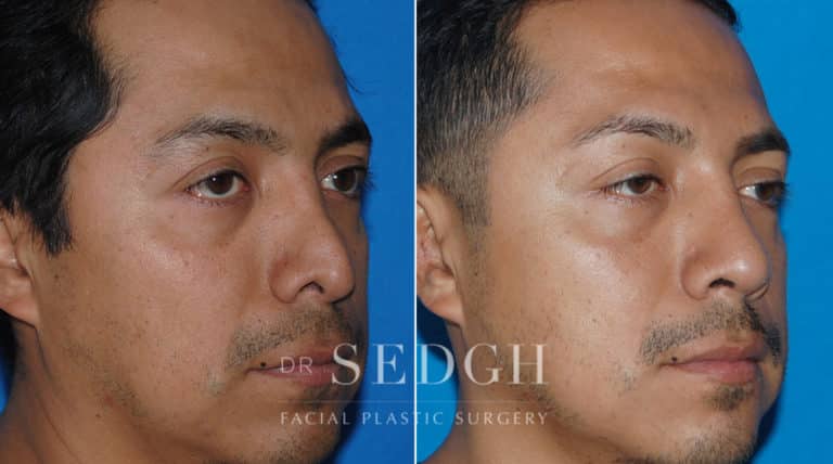 Latino Rhinoplasty Before and After | Sedgh