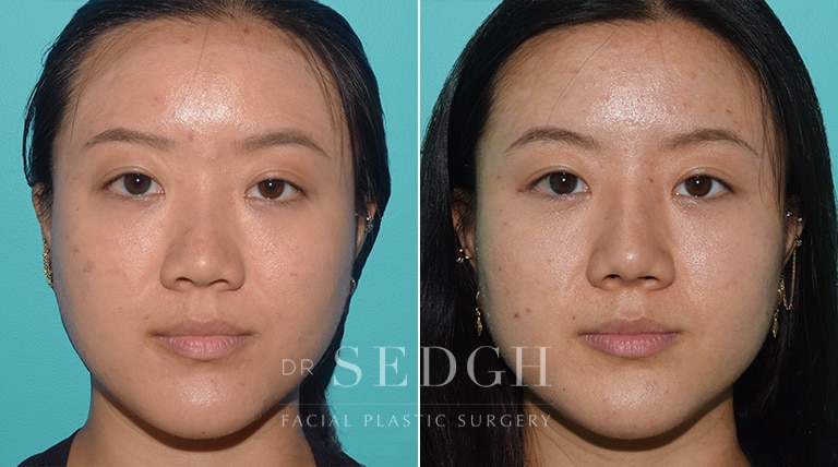 Asian Rhinoplasty Before and After | Sedgh