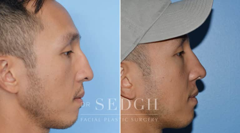 Asian Rhinoplasty Before and After | Sedgh