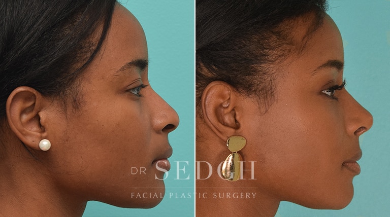 African American Rhinoplasty Before and After | Sedgh