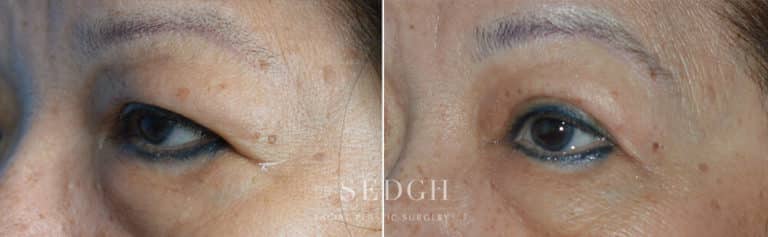 Upper Blepharoplasty Before and After | Sedgh