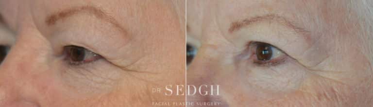 Upper Blepharoplasty Before and After | Sedgh