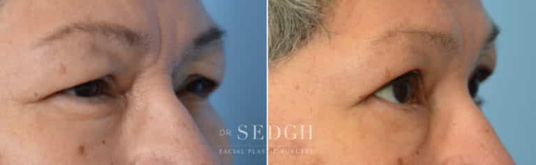 Upper Blepharoplasty Before and After | Sedgh