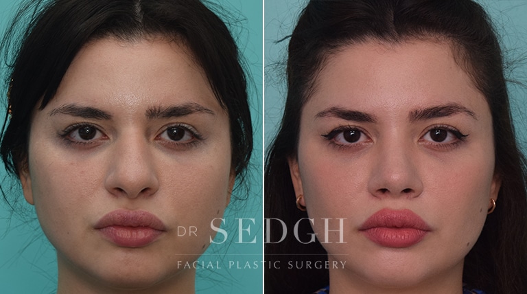 Rhinoplasty Before and After | Sedgh