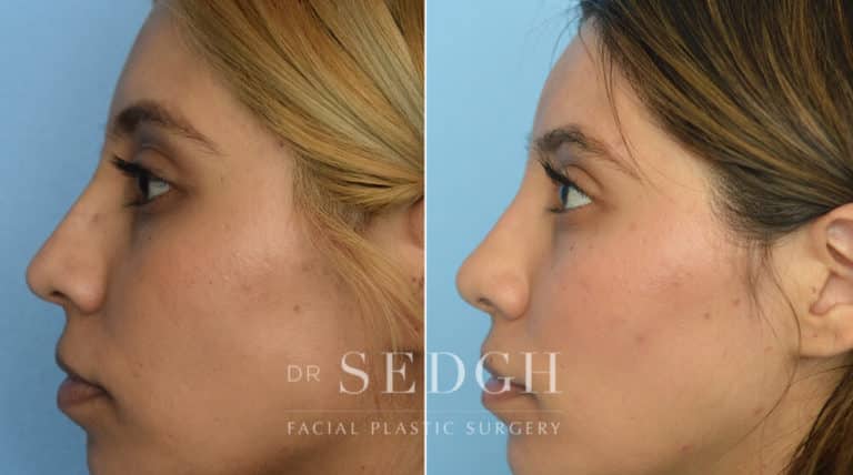 Rhinoplasty Before and After | Sedgh