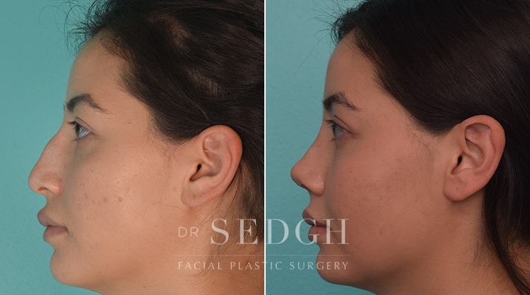 Rhinoplasty Before and After | Sedgh