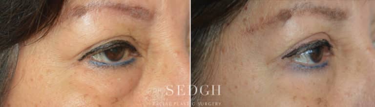 Lower Blepharoplasty Before and After | Sedgh