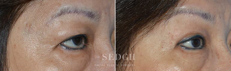 Brow Lift Before and After | Sedgh