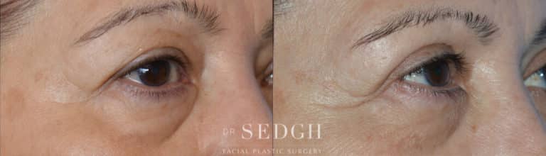 Brow Lift Before and After | Sedgh