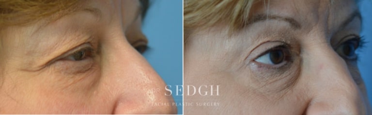 Brow Lift Before and After | Sedgh