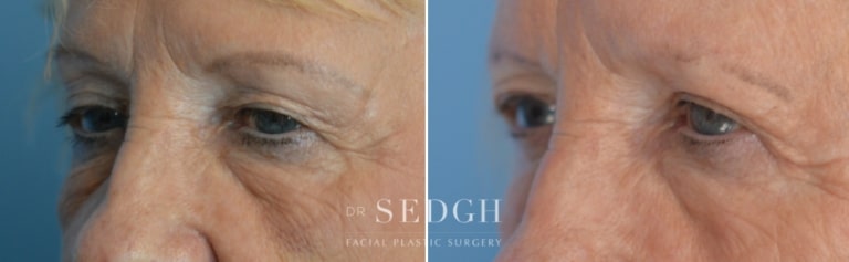 Brow Lift Before and After | Sedgh