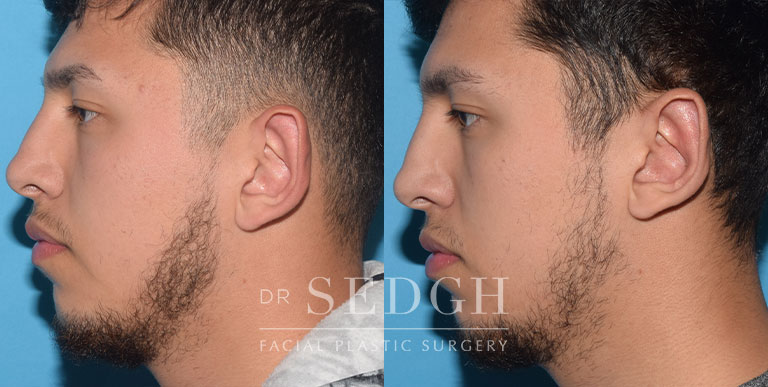 Ear Pinning Surgery Before and After | Sedgh