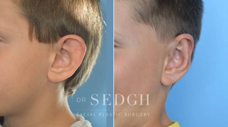 Ear Pinning Surgery Before and After | Sedgh