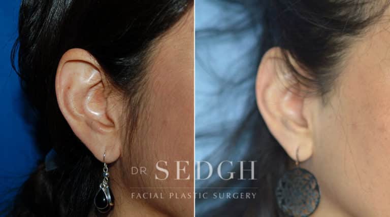 Ear Pinning Surgery Before and After | Sedgh