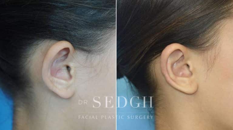 Ear Pinning Surgery Before and After | Sedgh