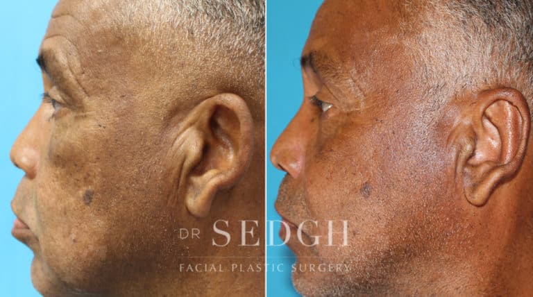 Ear Pinning Surgery Before and After | Sedgh