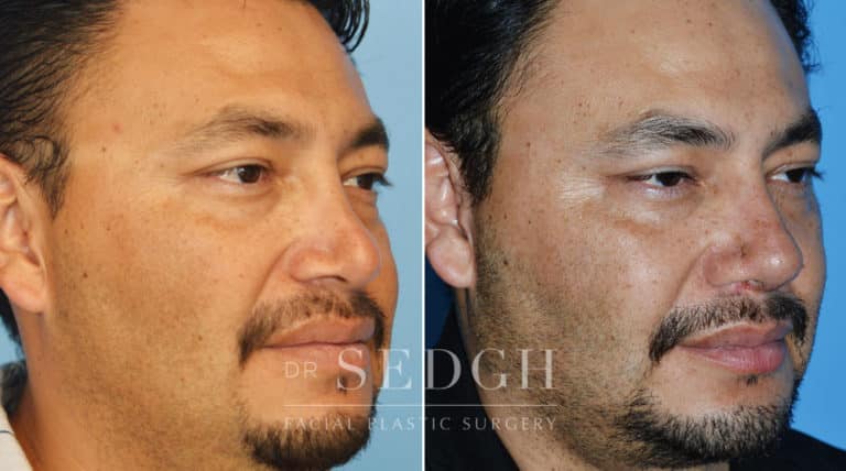 Neck Liposuction Before and After | Sedgh