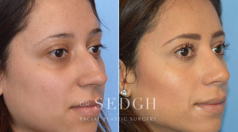 Rhinoplasty Before and After | Sedgh