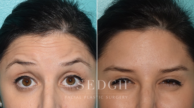 Wrinkle Relaxers Before and After | Sedgh