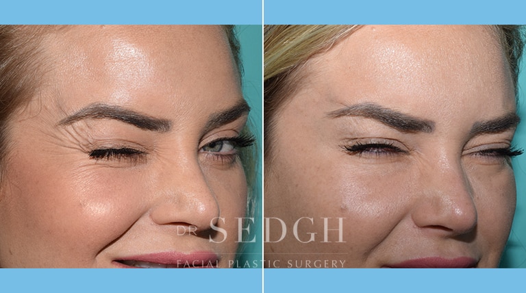 Wrinkle Relaxers Before and After | Sedgh