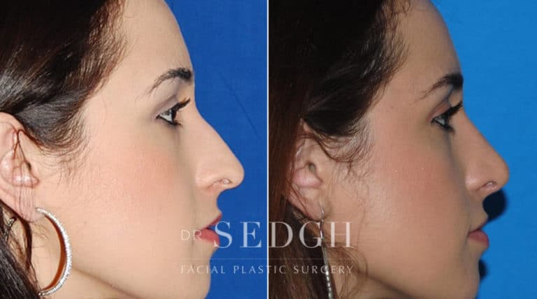 Rhinoplasty Before and After | Sedgh