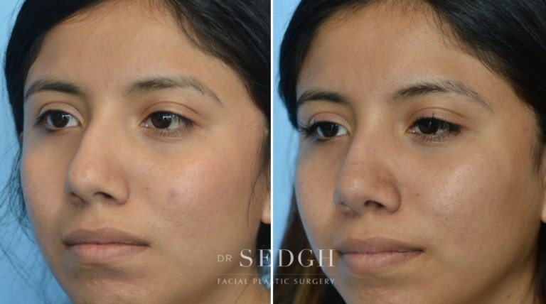 Rhinoplasty Before and After | Sedgh