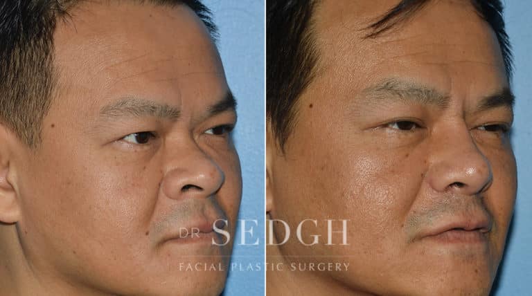 Rhinoplasty Before and After | Sedgh
