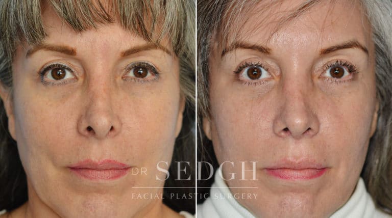 Revision Rhinoplasty Before and After | Sedgh