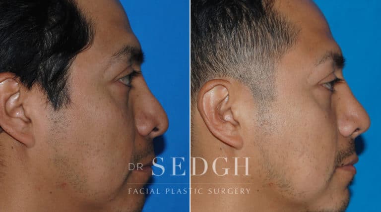 Revision Rhinoplasty Before and After | Sedgh