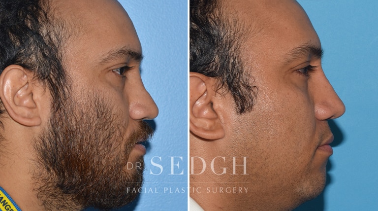 Rhinoplasty Before and After | Sedgh