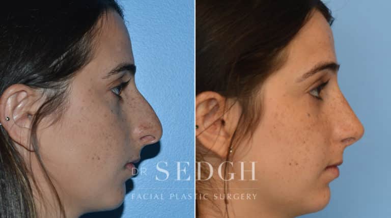 Rhinoplasty Before and After | Sedgh