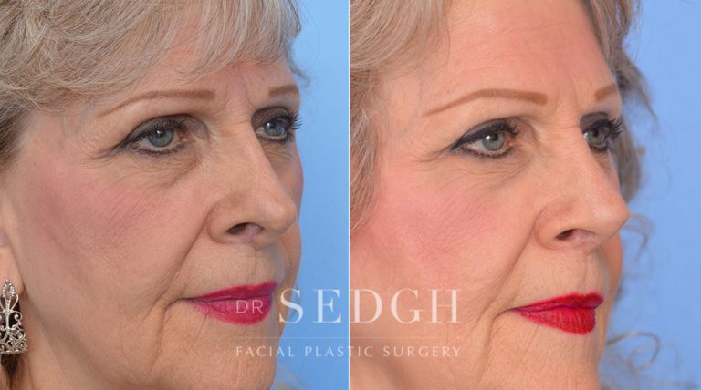 Revision Rhinoplasty Before and After | Sedgh