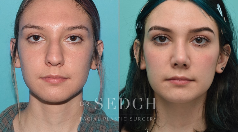 Rhinoplasty Before and After | Sedgh