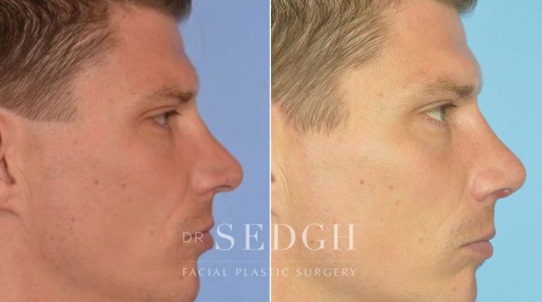 Rhinoplasty Before and After | Sedgh