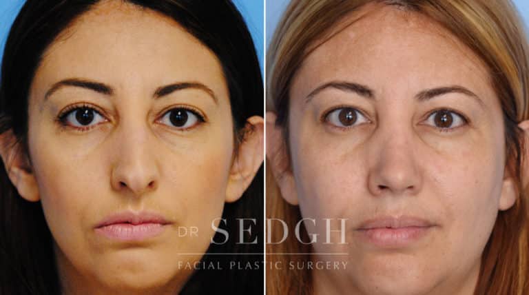 Rhinoplasty Before and After | Sedgh