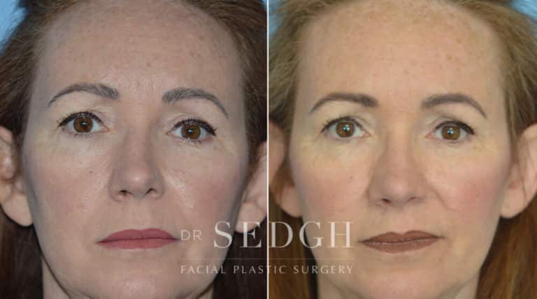 Rhinoplasty Before and After | Sedgh