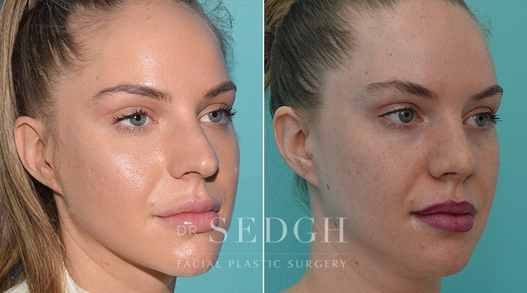 Crooked Nose Surgery Before and After | Sedgh