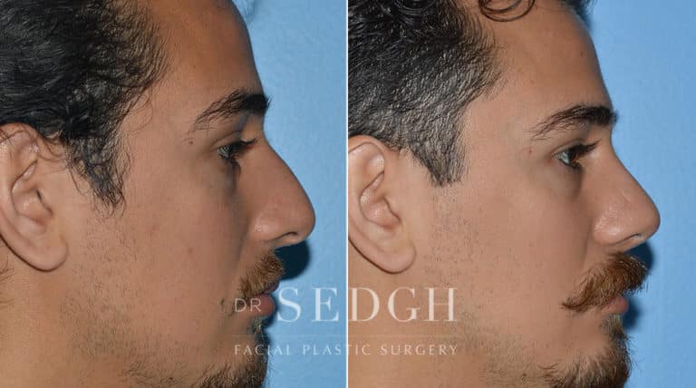 Rhinoplasty Before and After | Sedgh