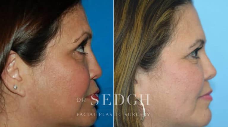 Crooked Nose Surgery Before and After | Sedgh