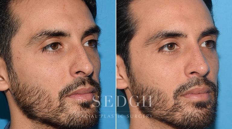 Rhinoplasty Before and After | Sedgh