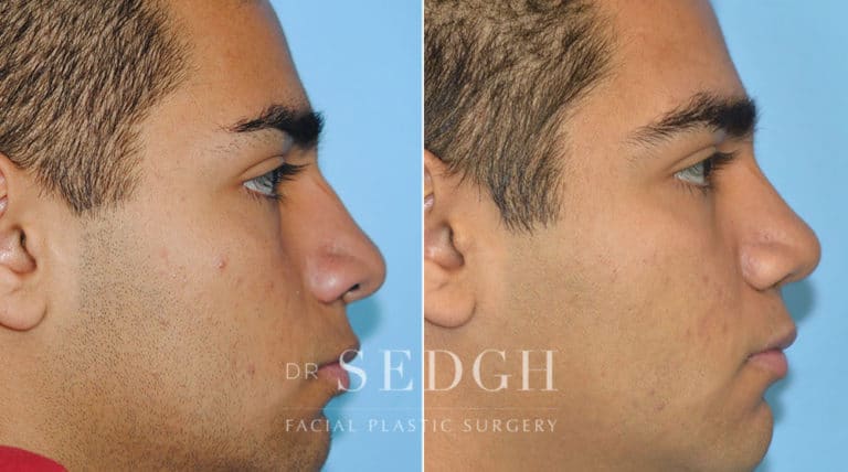 Crooked Nose Surgery Before and After | Sedgh