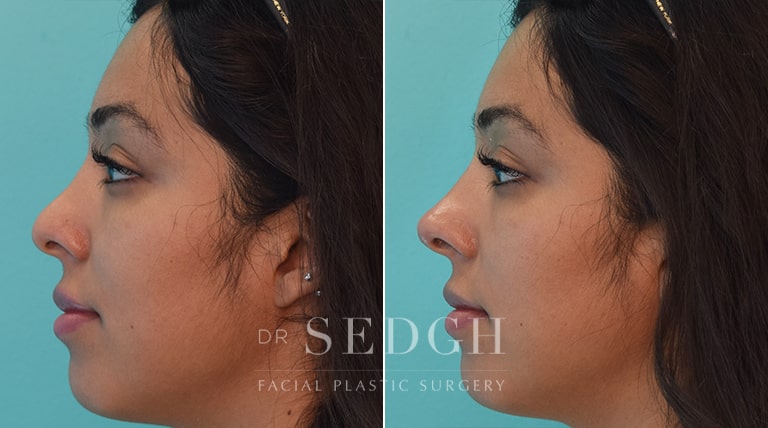 Facial Fillers Before and After | Sedgh