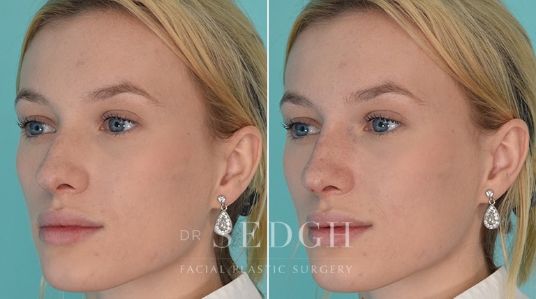 Facial Fillers Before and After | Sedgh